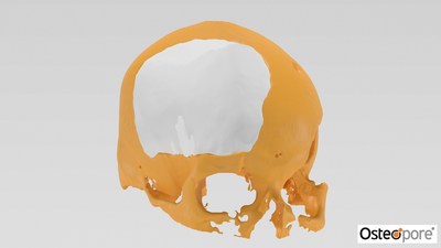 3D render of Osteopore’s customised implant fitting into a skull defect