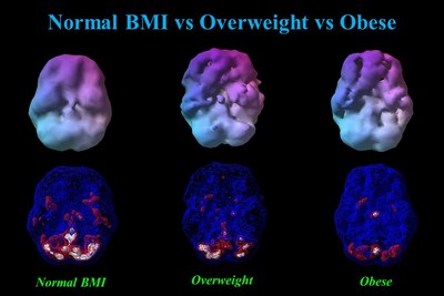This figure shows 3-D renderings of blood flow averaged across normal BMI (BMI = 23), overweight (BMI = 29), and obese (BMI = 37) men, each 40 years of age.