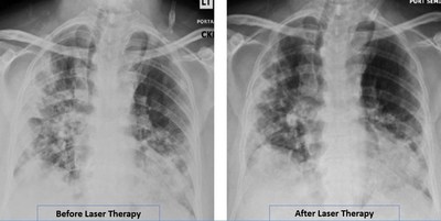 Radiographic Assessment of Lung Edema (RALE) by CXR showed reduced ground-glass opacities and consolidation following PBMT. Lung radiographic score is dependent on extent of involvement based on consolidation or ground-glass opacities for each lung. Total score is the sum of both lungs. RALE score before laser therapy=8. RALE score after laser therapy=5.