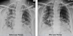 COVID-19 Pneumonia Patient Shows Significant Improvements Following Laser Treatment at Massachusetts Hospital