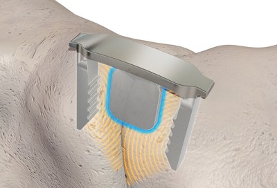 Keel-Lock Nitinol Implant for Foot Bone Fusion