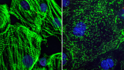 Healthy heart muscle (left) created from adult stem cells have long fibers which allow them to contract. SARS-CoV-2 infection causes these fibers to break apart into small pieces (right), which can cut off the cells ability to beat and may explain lasting cardiac defects in COVID-19 patients.