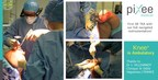 Pixee Medical Completes its First Total Knee Replacement Surgery Guided Solely by the Vuzix M400 Smart Glasses