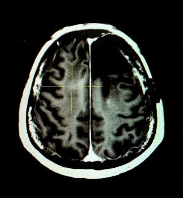 Figure 2. The patient's BBB was temporarily opened after the FUS treatment
