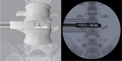 CoreLink OLIF additively manufactured Trials feature height and length measurements visible only under fluoroscopy to facilitate implant selection and operative workflow.