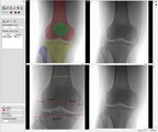 RSIP Vision Launches a New Knee Segmentation and Landmark Detection from X-ray Module