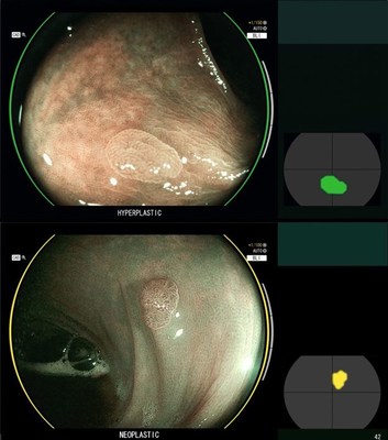 CAD EYE - Fujifilm Artificial Intelligence meets Endoscopy