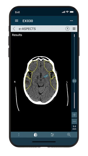 Brainomix Achieves Breakthrough in Stroke Imaging with New Software Release