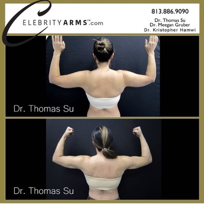 The Fat Sucker: Dr. Claudine Roura- All About Arm Liposuction