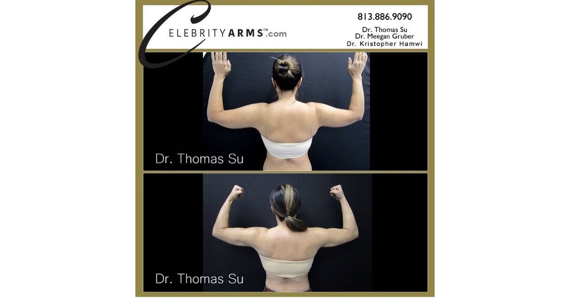 dr-sus-revolutionary-arm-liposuction-gives-women-the-desired-celebrity-arm-look