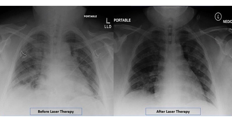 Doctors in Lowell, Mass., Report Positive Outcomes for Second COVID-19 ...