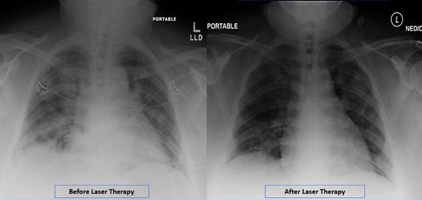 Radiographic Assessment of Lung Edema (RALE) by CXR showed reduced ground-glass opacities and consolidation following PBMT. Lung radiographic score is dependent on extent of involvement based on consolidation or ground-glass opacities for each lung. Total score is the sum of both lungs. RALE score before laser therapy=8. RALE score after laser therapy=3.