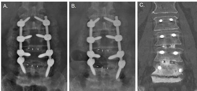 AP radiograph of Tyber Medical’s titanium-integrated Polyetheretherketone (PEEK) interbody fusion device at A. 2 months and B. 5 months showing early integration with the vertebral endplates. C. Coronal CT scan at 10 months showing bone bridging across the interbody space. Images courtesy of Dr. Matthew Gary of the Emory Spine Center.
