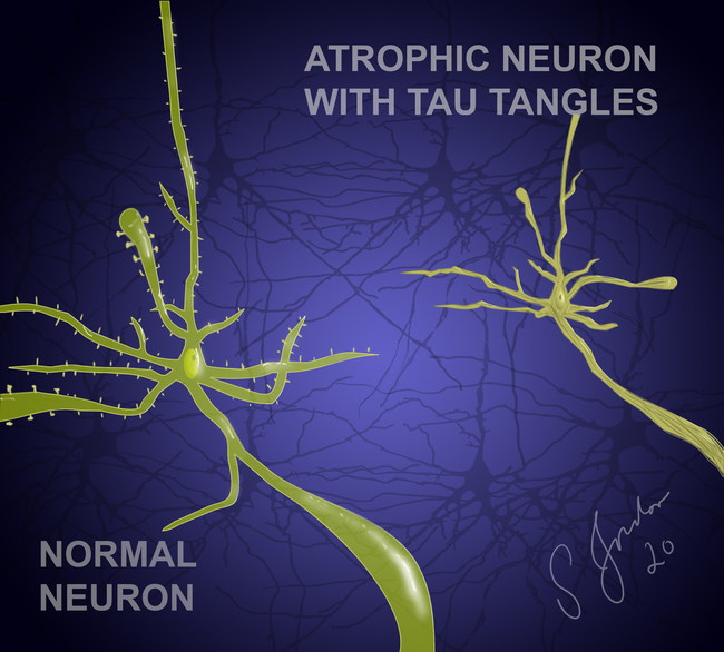 In Alzheimer's disease and other neurodegenerative diseases, there is an abnormal accumulation of toxic proteins which cause the nerve cell to shrink and become dysfunctional. In Alzheimer's disease, it's tau proteins which accumulate in structures called neurofibrillary tangles.