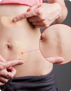 myScarTape Can Restore Normalcy and Confidence to a Life Disrupted by Scarring