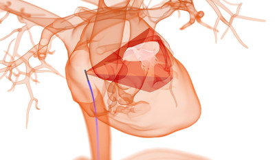 NuVera Medical's NuVision ICE Catheter