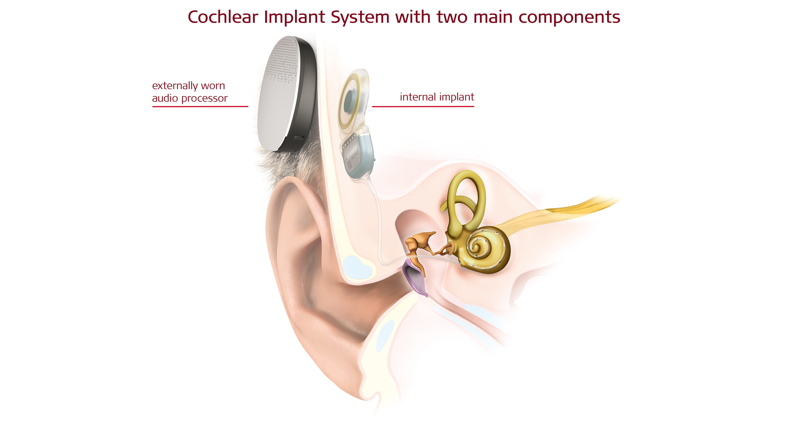 Hear system. Кохлеарный имплантат Medel. Processor of Cochlear Implant. Cochlear Implant 6.