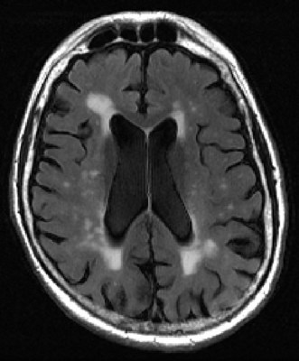 MRI image of human brain shows multiple bright spots (white matter hyperintensities) in center Courtesy of Elsevier/Academic Radiology