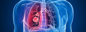 Roche receives FDA approval for the cobas EGFR Mutation Test v2 as the first companion diagnostic test for expanded EGFR TKI therapies in patients with non-small cell lung cancer