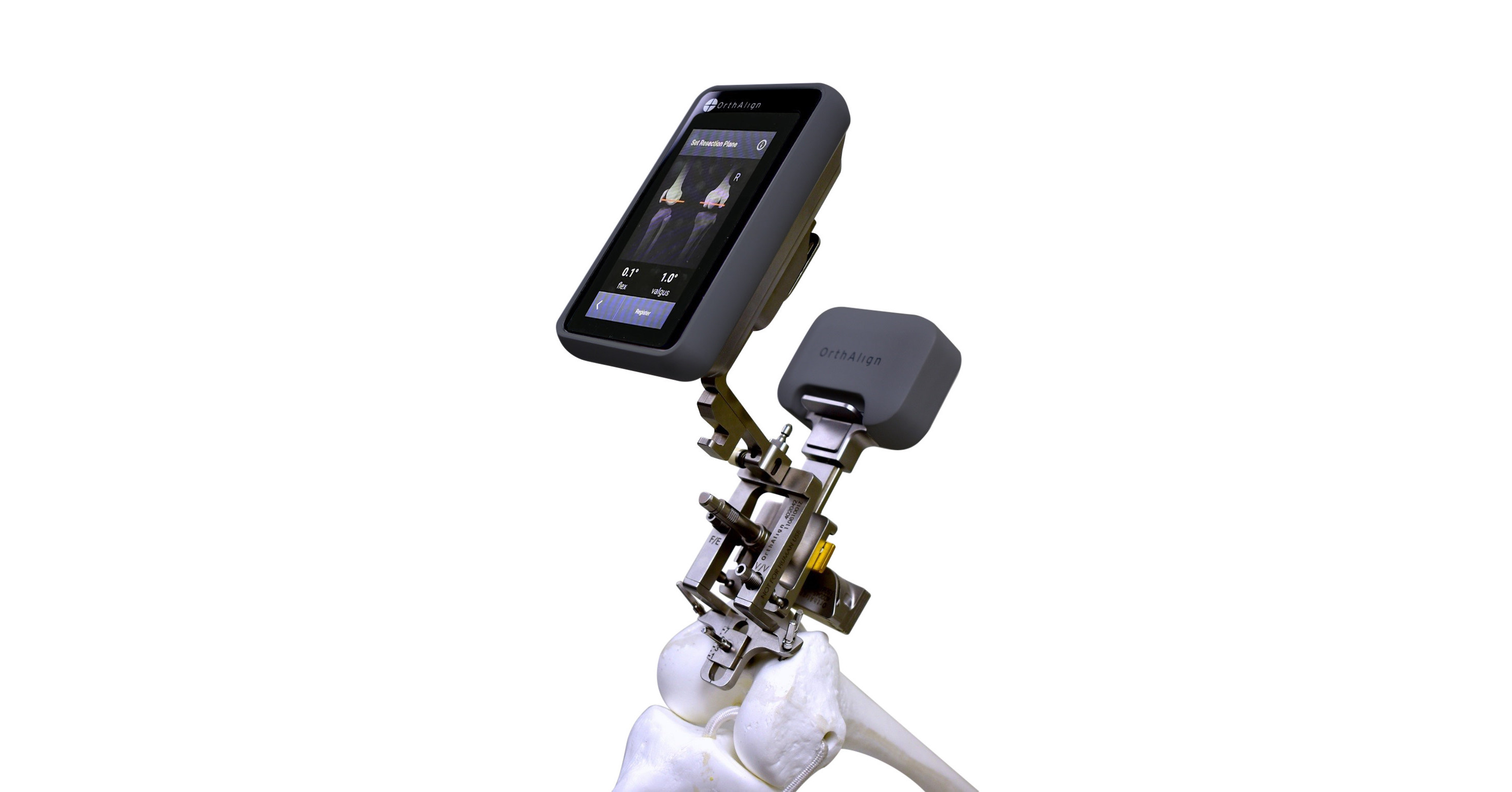 OrthAlign, Inc. Announces First Cases Using LANTERN™ Surgical Assistant