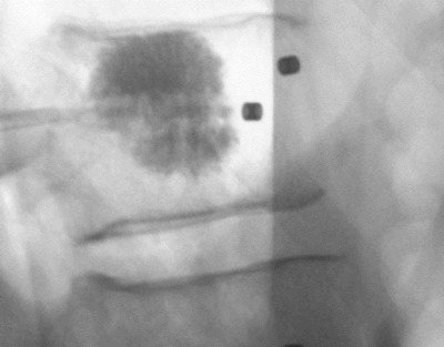 Lateral x-ray image of a vertebral body instrumented with VADER® pedicle screws including cement augmentation