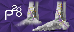 Paragon 28, Inc. Increases its Robust Ankle Fusion Plating Offering - Silverback™ Posterior Plating System Launched