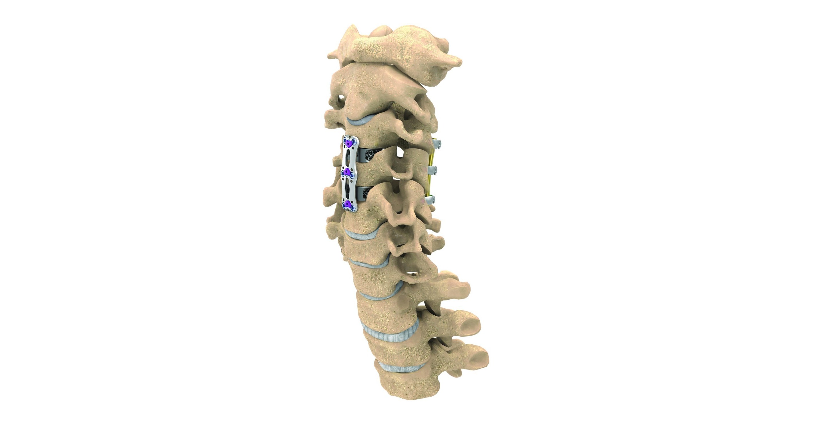 nuvasive-unveils-c360-portfolio-and-launches-new-anterior-cervical-plate