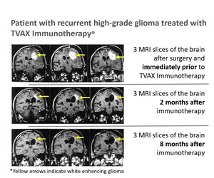 TVAX Biomedical announces major advancements in potential Glioblastoma cure