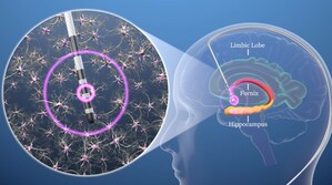 Functional Neuromodulation Announces Breakthrough Device Designation from the U.S. FDA for Deep Brain Stimulation for Alzheimer's Disease