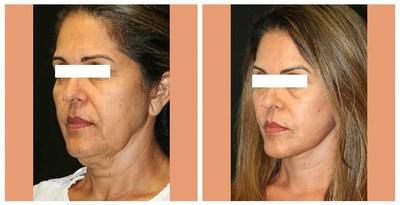 A before and after photo of a SmartLift™ facelift by Dr. Alberico Sessa of Sarasota Surgical Arts.