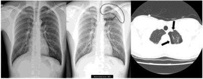 Lunit INSIGHT CXR marks the location and probability of an abnormal finding on chest radiograph