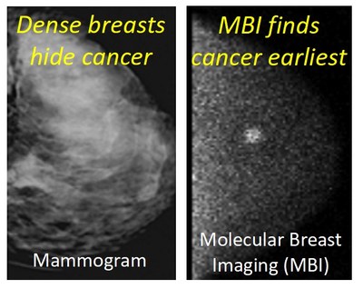 Comparison of mammogram in dense breast tissue that appeared “normal” and the MBI scan which detects a hidden early stage invasive cancer (courtesy of Mayo Clinic).