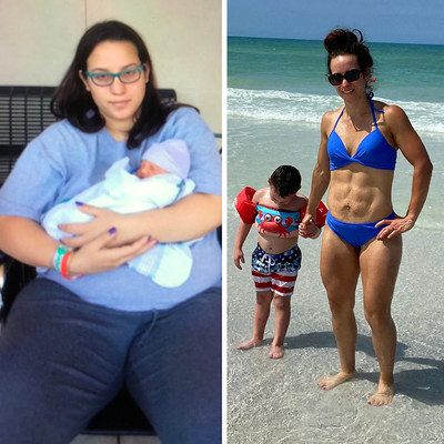 30-year-old mother of two and ER nurse from Tampa, FL - Before & After Photo