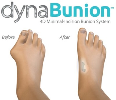 DynaBunion 4D Minimal Incision Bunion Correction - Before & After