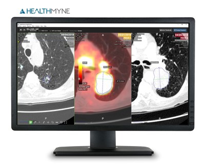 HealthMyne’s AI-enabled radiomic solutions provide access to critical imaging data that lies below the surface. As pictured in the Lung PET CT image viewer, a tumor is segmented and high- dimensional characteristics are revealed over multiple time points through HealthMyne®. Over 1500 unique validated Radiomic Precision Metrics (RPM™) are extracted to inform personalized patient management, treatment decisions, and response to therapy.