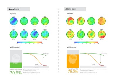 AI cloud based-EEG brain mapping results of normal vs. aMCI (preclinical AD) by iSyncBrain