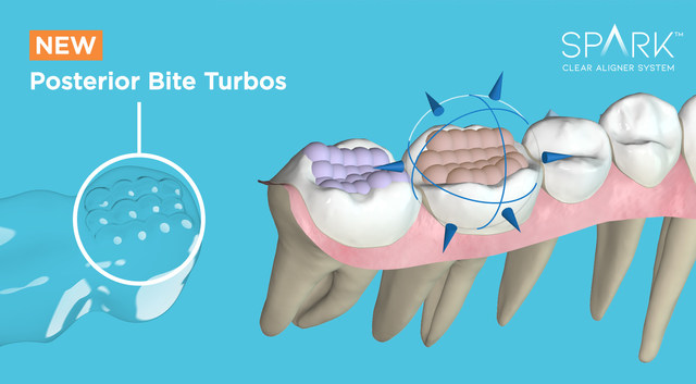 Spark Clear Aligners Announces Most Substantial Upgrade