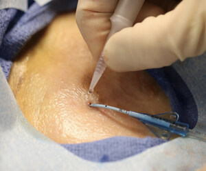 2021 INS Standards Recognize SecurePortIV® Tissue Adhesive as Standard of Care