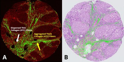 Figure 1: Picture A shows a patient's TNBC biopsy scanned by HistoIndex's stain-free AI digital pathology platform. The collagen fibers as well as changes in collagen structures are highlighted in green when detected by SHG and shows a comparison of the tissue area occupied by the ATC and DTC fibers based on intensity, texture, and morphology. Picture B shows an overlay of the collagen structure acquired by SHG onto an image stained with Haemotoxylin and Eosin (H&E), which is commonly used in conventional pathology. With SHG imaging, the ATC and DTC fibers were revealed to be of prognostic value based on the patient cohort and clinical outcomes. And when analyzed separately, the key collagen-associated parameters provided a novel understanding of collagen remodeling during cancer progression [3]. Image Credits: Institute of Molecular and Cell Biology.
