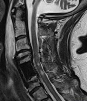 MRI sagittal view: Improved postoperative follow-up with icotec Anterior Cervical Plate and KONG-C VBR M