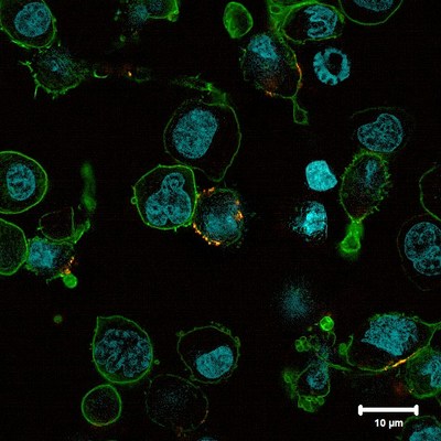 Figure 1: A tumor cell (left: cell nucleus [blue], cell surface [green]) is tackled by a reprogrammed immune cell (right: synthetic CAR [yellow]). Universittsklinikum Wrzburg.