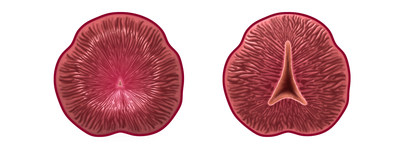 Views of the prostatic urethra before (left) and after (right) treatment with iTind, a temporarily implanted nitinol device that reshapes the prostatic urethra by gently expanding over 5 to 7 days to create new channels through which urine can flow. A new study shows that the iTind provides rapid and effective relief of enlarged prostate symptoms while maintaining sexual function.