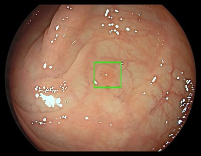 The GI Genius™ intelligent endoscopy module works in real-time, automatically identifying and marking (with a green box) abnormalities consistent with colorectal polyps, including small flat polyps.