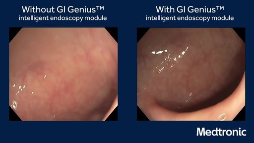 This side-by-side comparison shows a colonoscopy with and without the GI Genius™ intelligent endoscopy module. The GI Genius module works in real-time, automatically identifying and marking (with a green box) abnormalities consistent with colorectal polyps, including small flat polyps.