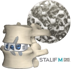 Centinel Spine's STALIF M FLX™ Listed as Top ALIF 3D-printed Cage