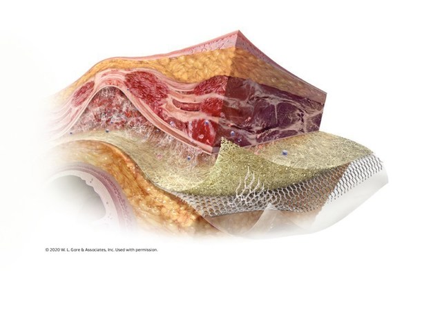 W.L. Gore & Associates Launches GORE® SYNECOR Intraperitoneal ...