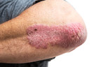 AbbVie's SKYRIZI® for the Treatment of Moderate to Severe Plaque Psoriasis now Publicly Reimbursed across Canada