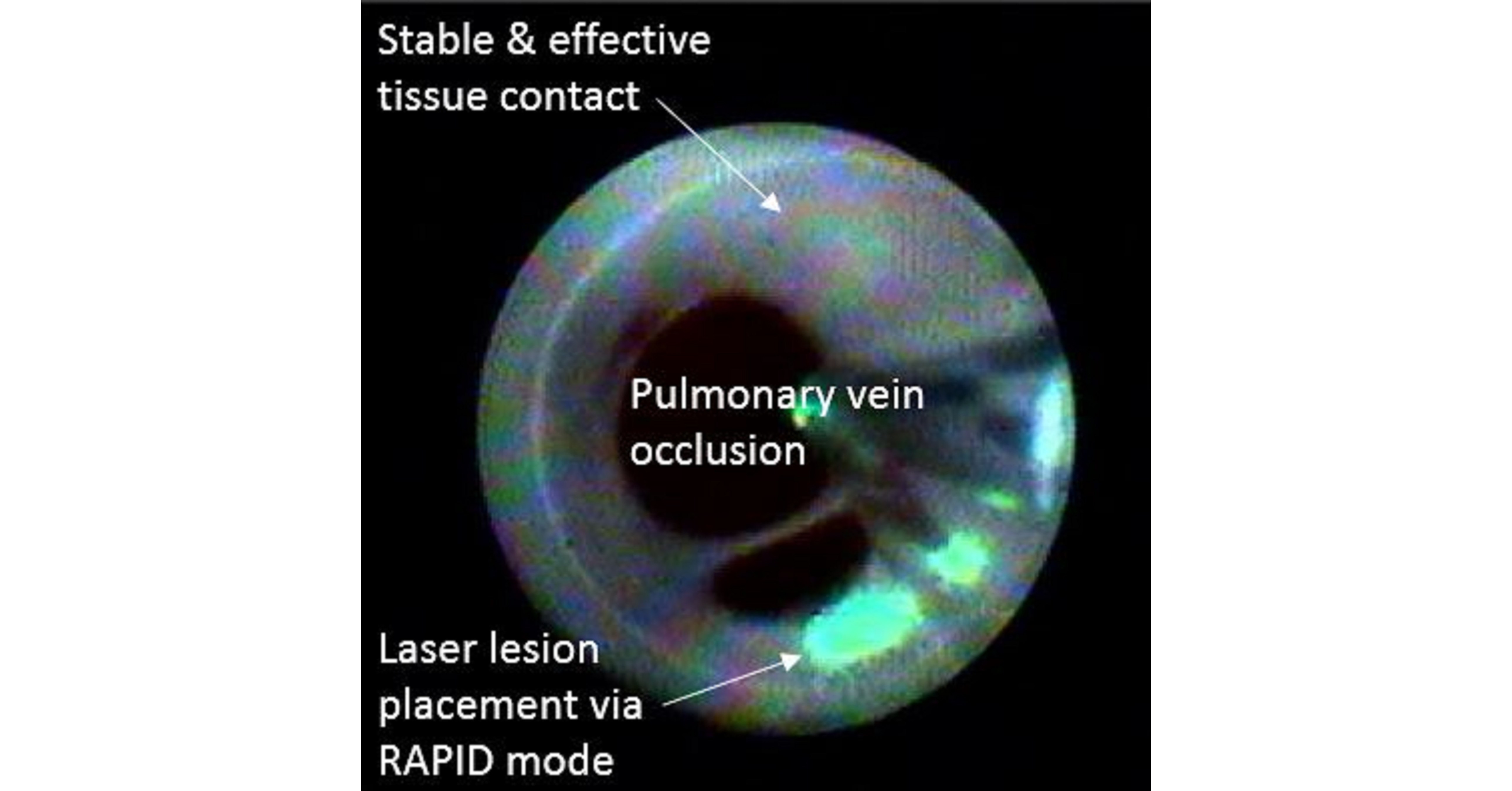 CardioFocus Announces The Publication Of HeartLight X3 Pivotal Study Data