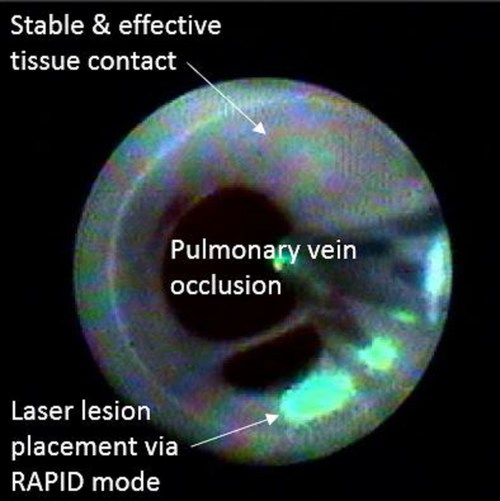 Image highlighting HeartLight X3’s direct visualization feature. Here we see a fully occluded pulmonary vein with stable and effective contact (white circumferential area). The endoscopic ablation systems laser is seen in green at 5 o’clock delivering a RAPID mode lesion set.
