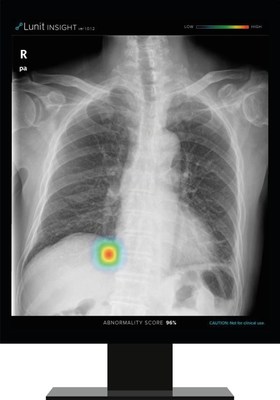 Lunit INSIGHT CXR detects findings and provides abnormality score on a chest X-ray image